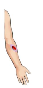 Ematomi - Untitled design 16